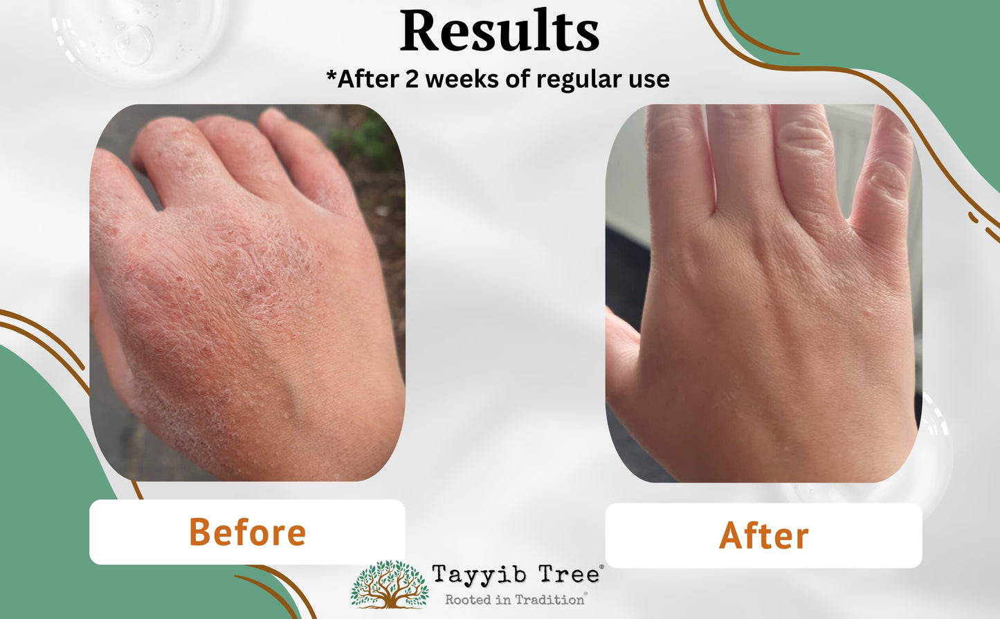 Tallow Cream for Eczema