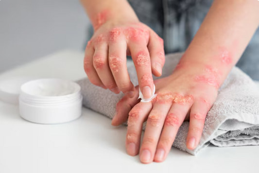 Tallow balm for eczema and irritated skin relief